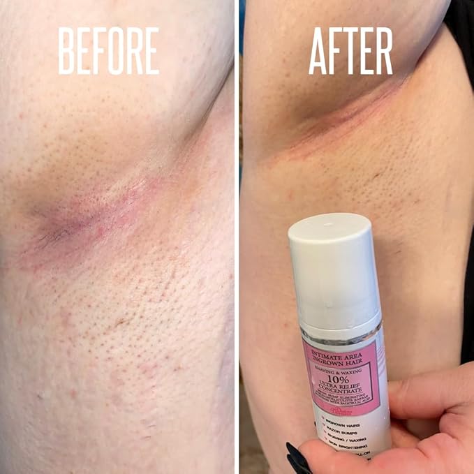 Save 14% on The Skin Care Solution For Dark Spots, Razor Bumps, Ingrown Hair & Razor Burns ā Includes Our Ultra Potent Brightening + Razor Bumps Solution For an Ultra Clear & Glowing Skin