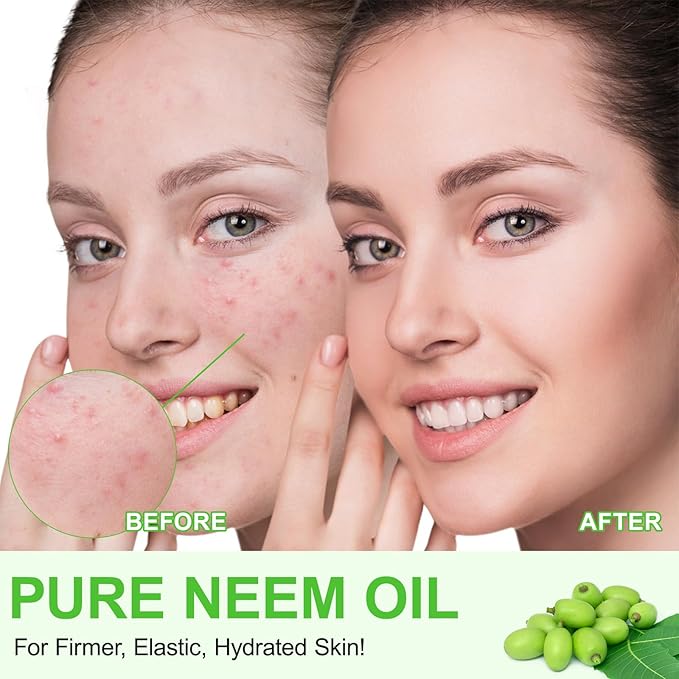 Neem Oil for Skin – 100% Natural Cold Pressed Neem Oil - for Face, Skin Care, Hair Care, Scalp Massage & Body Massage,Hair Growth, Acne, Anti-Aging Moisturizer (2.02 Fl Oz)
