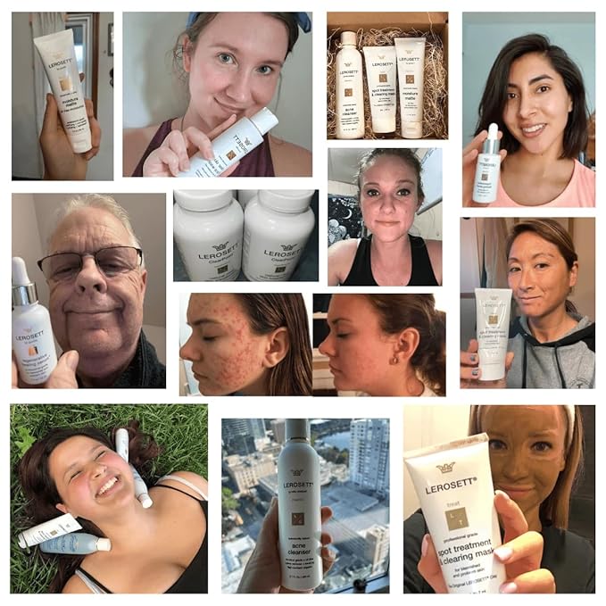 LEROSETT Serum for Acne Scarring Healing, Pimples, Redness, Breakouts, Blemishes, Hydrate & Soothes Irritated Skin, Natural Serum. Spa-Grade, Plant Based, Concentrated - 4 oz