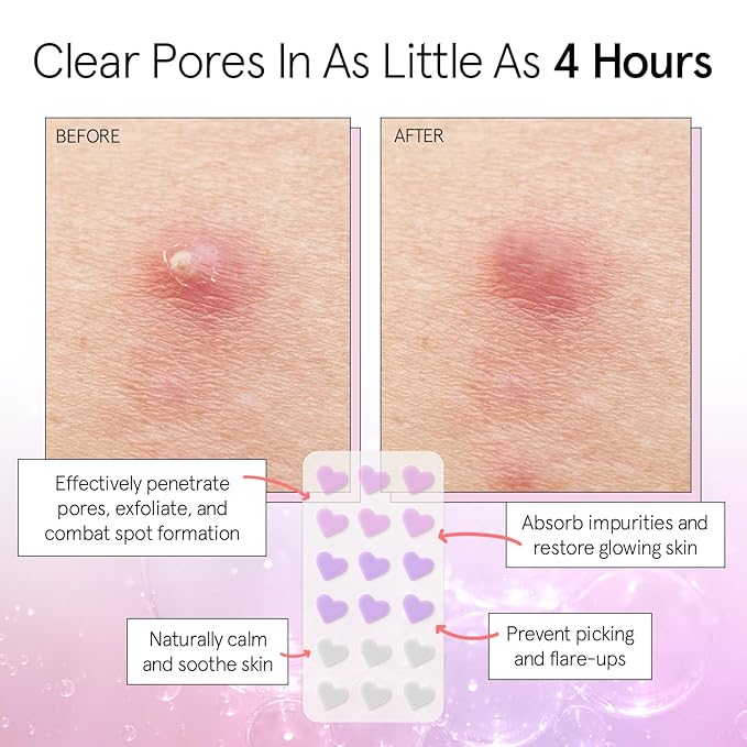 grace & stella Pimple Patches for Face- Heart Hydrocolloid Zit Stickers that Help Soothe & Conceal Breakouts - Colorful Covers for Acne Prone Skin - Dermatologist-Tested, Vegan (Heart, 36 Count)
