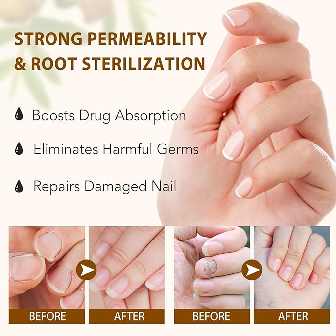 Ginger Nail Treatment, Nail Growth Serum, Ginger Nail Serum, Nail Repair Cuticles Oil, Ginger Nail Oil for Strengthen nails & Promote Nail Growth, Natural Plant Formula