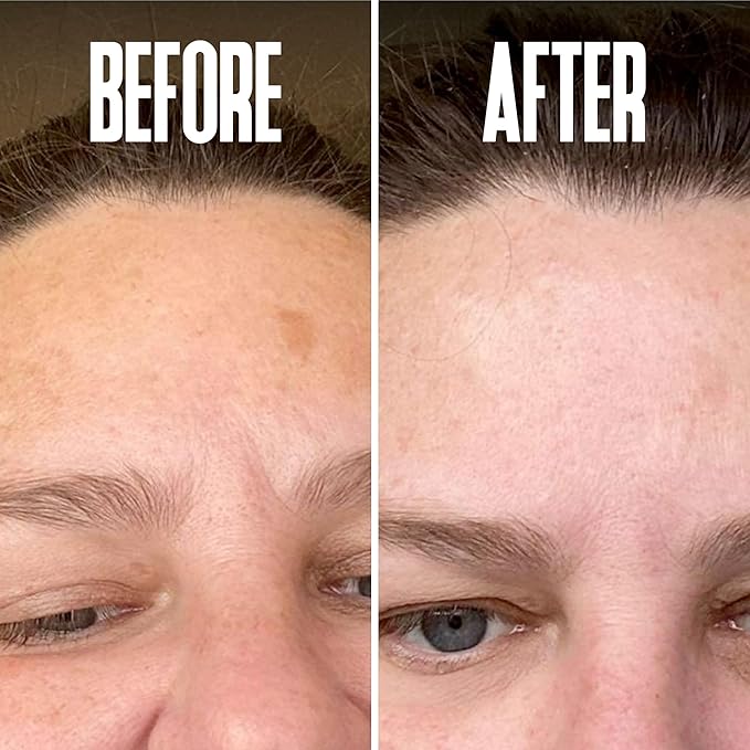 Save 14% on The Skin Care Solution For Dark Spots, Razor Bumps, Ingrown Hair & Razor Burns ā Includes Our Ultra Potent Brightening + Razor Bumps Solution For an Ultra Clear & Glowing Skin