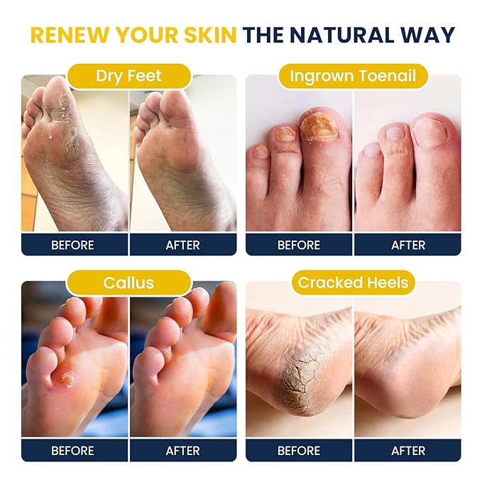 Citrus Detox Foot Soak with Epsom Salts for Foot Callus, Immune Boost, Damaged Toenail, Athletes Foot, Pedicure Callus Remover for Feet with Extra Strength Gel & Foot Pumice Stone Set