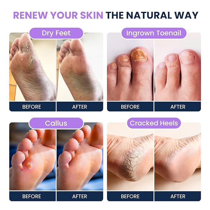 Soothing Lavender Foot Soak with Epsom Salt - Best Toenail Treatment, & Softens Calluses - Soothes Sore & Tired Feet, Callus Remover for Feet with Extra Strength Gel & Foot Pumice Stone Set
