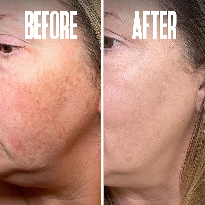 Save 14% on The Skin Care Solution For Dark Spots, Razor Bumps, Ingrown Hair & Razor Burns ā Includes Our Ultra Potent Brightening + Razor Bumps Solution For an Ultra Clear & Glowing Skin