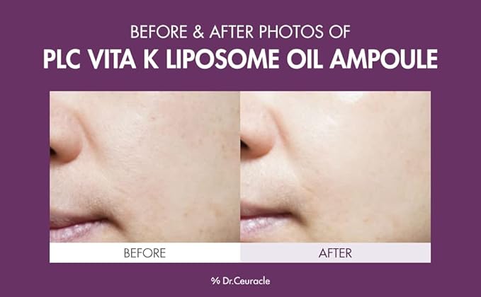 Dr.Ceuracle PLC Vitamin K Liposome Oil Ampoule - Korean Vitamin K Face Serum for Evening Skin Tone and Relieving Imperfections (50 ml / 1.69 fl. oz.)
