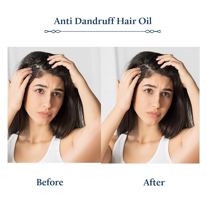 Blue Nectar Anti Dandruff Hair Oil with Neem & Tea Tree| Ayurvedic Non-Stickyfor Dry Scalp | Plant Based for Men & Women (12 Herbs, 6.76FlOz)