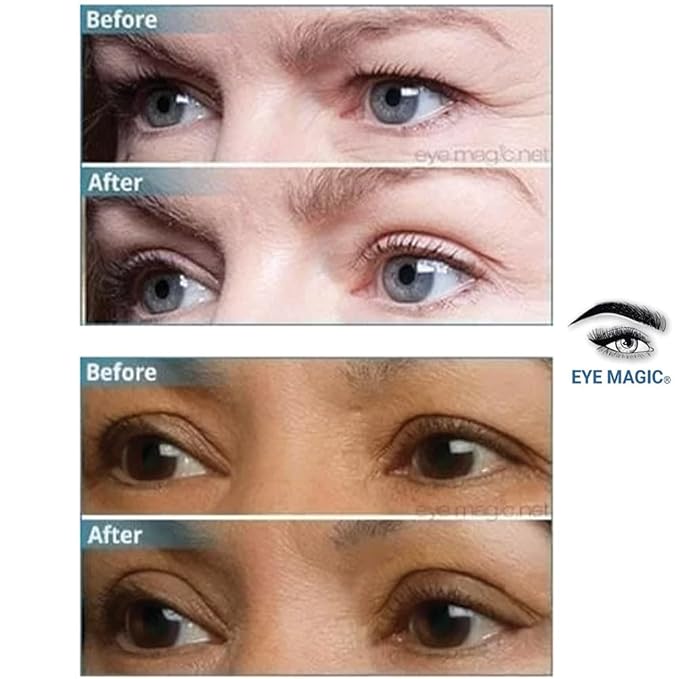 Original Eye Lift Kit (Small/Medium Size With Gel) Lifts Eyelid Droop and Hooded Eyes | Open And Show Off Your Beautiful Eyes | Made In America