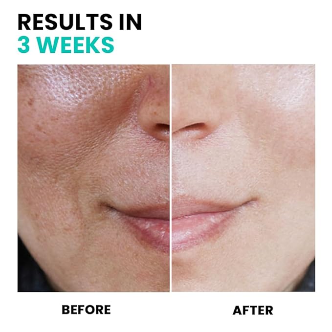 Conatural Anti-Pigmentation Serum 30ml - Dark Spot Corrector Serum for Hyperpigmentation, Dark Spots, & Dull Skin- Targeted Treatment with Antioxidants for Effective Dark Spot Removal