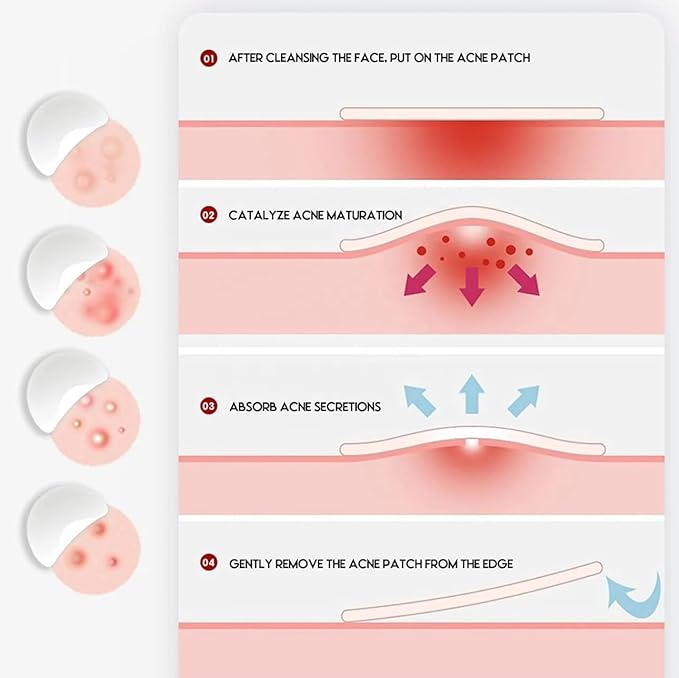 ZitZap Pimple/Acne Patches For Face And Skin, Hydrocolloid Patches With Salicylic Acid And Tea Tree Oil For Covering Zits And Blemishes.
