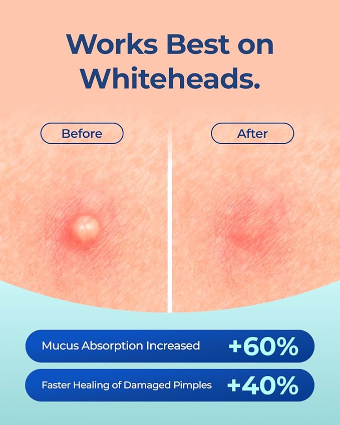 Pimple Patches for Face Acne: Invisible 0.1mm Ultra-Thin Hydrocolloid Zit Stickers with Tea Tree Oil - 308 Dots, 2 Sizes (Whiteheads/Sensitive Skin)