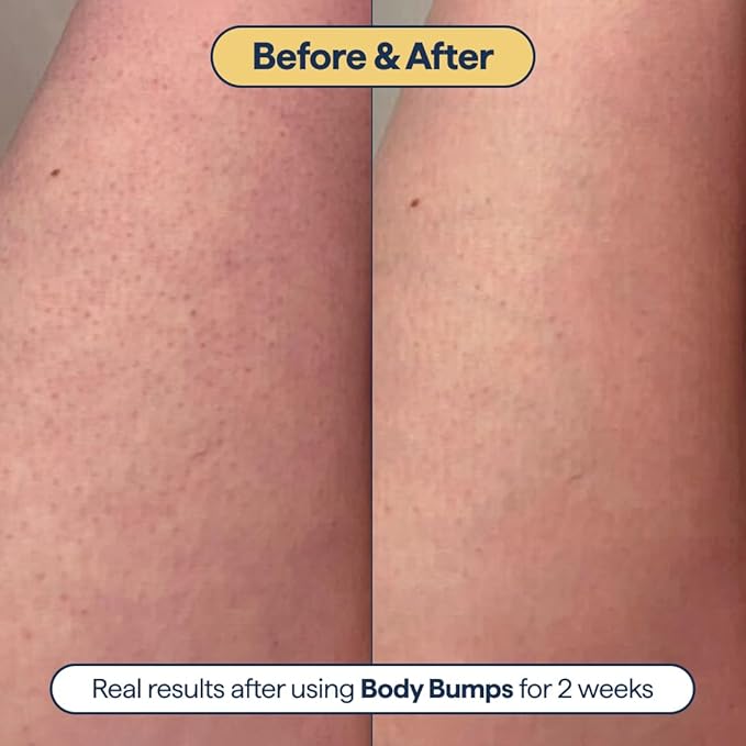 Remedy for Body Bumps – Treatment for Keratosis Pilaris (KP) and Textured, Crepey Skin with Urea, Lactic Acid, and Retinol -– Smoothing Body Moisturizer Lotion – By Dermatologist Dr. Shah