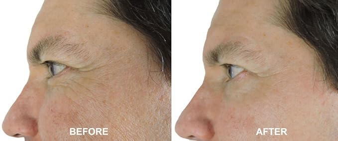 DNA Code®-No Needle Alternative-Pure Argireline Peptides Wrinkle Reduce Serum+ Matrixyl 3000+Hyaluronic Acid