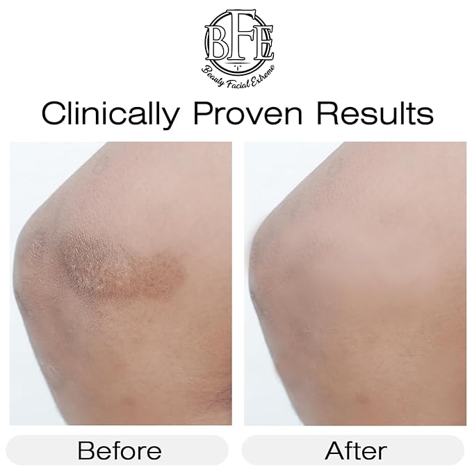 Vitamin K Cream- Moisturizing Bruise Healing Formula. Dark Spot Corrector for Bruising, Spider Veins & Broken Capillaries. Reduces Under Eye Dark Circles, Fine Lines, Puffiness, & Wrinkles.