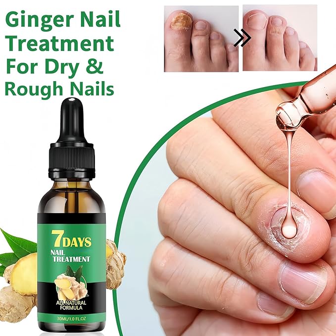 Ginger Nail Treatment-Nail Strengthener for Damaged Nails-Mild Nail Growth Serum for Gingernail & Toenail-Easy to Use, 1Pc 30ML