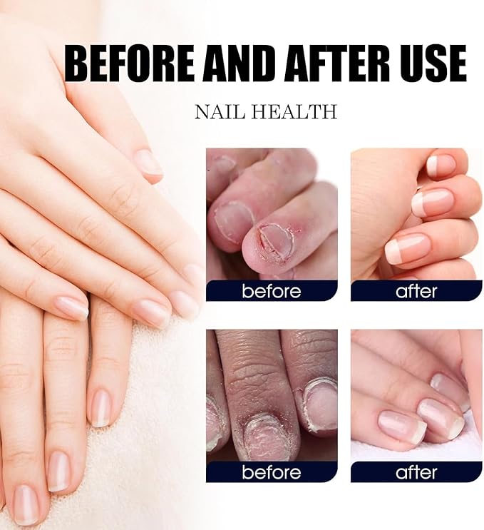 2PCS Ginger Nail Treatments, 7 Days Ginger Cuticle Care Oil for Nails,Nail Repair Cuticles Oil,Ginger Nail Oil for Strengthen nails & Promote Nail Growth, Natural Plant Formula