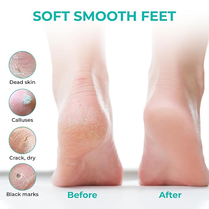 Happy Feet Foot Peel Mask, 03 Packs Original Exfoliant Foot Peel Mask, Callus Remover for Rough Cracked Dry Feet Dead Skin, Gift for Mom Dad