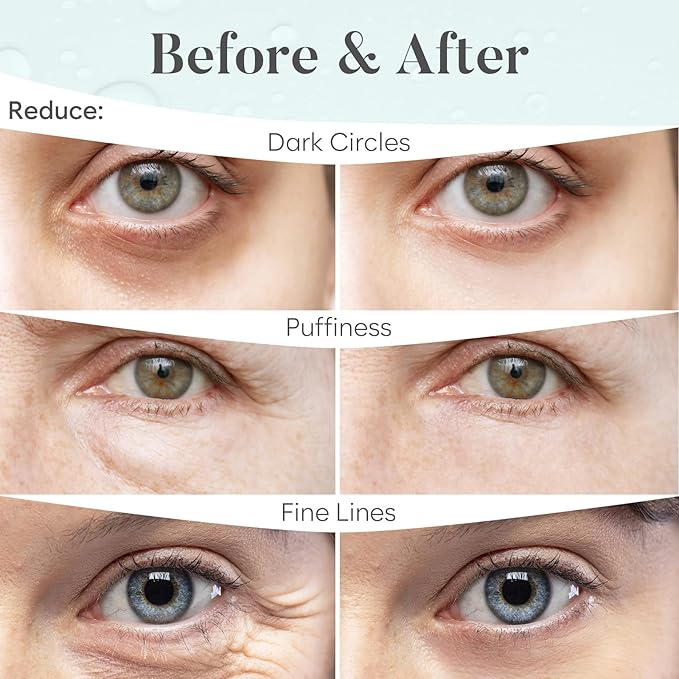 Hyaluronic Acid Under Eye Patches(30 Pairs) Under Eye Patches for Dark Circles, Under Eye Patches for Puffy Eyes and Dark Circles, Under Eye Mask, Eye Care, Puffy Eyes Treatment