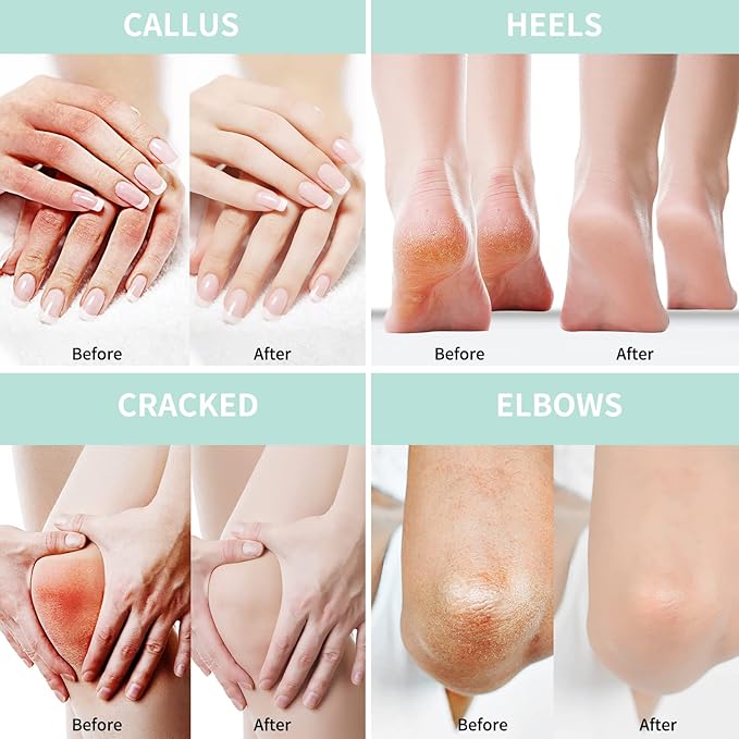 2 Packs Urea Cream 20% Plus 2% Salicylic Acid 5.3oz || Foot Cream Maximum Strength with Hyaluronic Acid, Tea Tree and Aloe Vera for Deep Moisturizes, Callus Remover and Soften