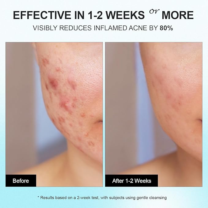 Acne Pimple Spot Treatment Cream: Cystic Hormonal Blackheads Blemish Remover for Face, Back and Body - with 10% Azelaic Acid - Teens 13-19 & Young Adult 20-30, 1.8 oz