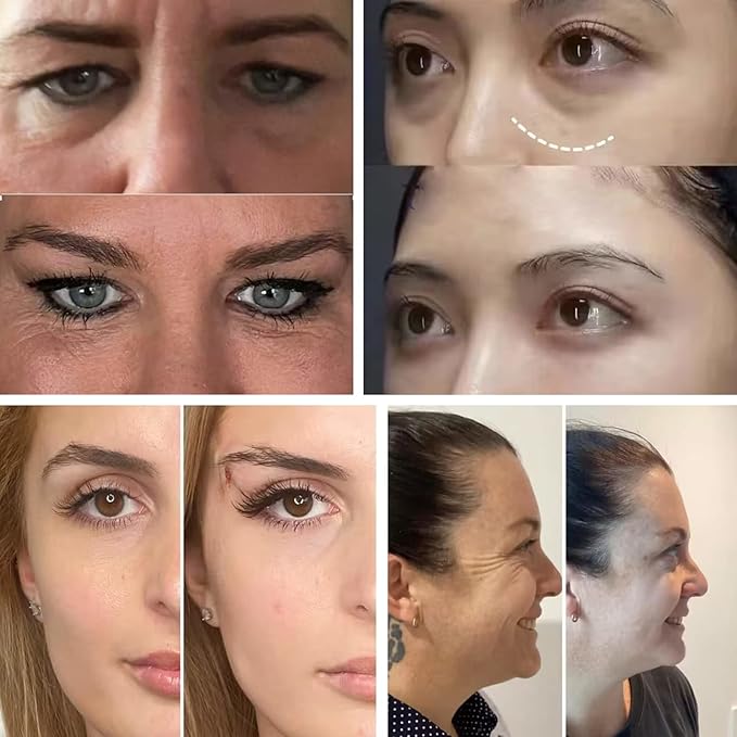 ACADA Pdo Threads for Eye Lift Face Lift Pdo Screw Threads for Eyes lift 30G25mm 40Pcs B-Type, Pdo Periocular Threads, Pdo Threads Eyes