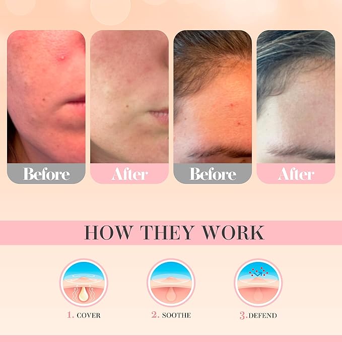 Glacia Pimple Patches 240 Pack