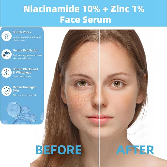 10% Niacinamide + 1% Zinc Face Serum, Nourishing & Refreshing Facial Serum ， Women Serum for Oil Control and Acne 30ML/1 Fl Oz