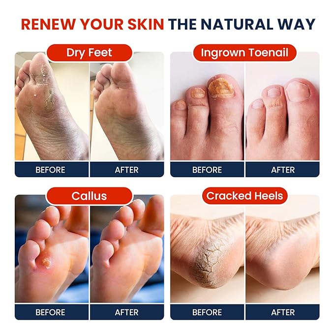 Muscle Relief Foot Soak with Epsom Salts - All Natural Salts for Post Workout - Easy Way to Remove Hard Calluses & Dead Skin Build-Up - Professional at Home Foot Care for Men & Women - Made in The USA