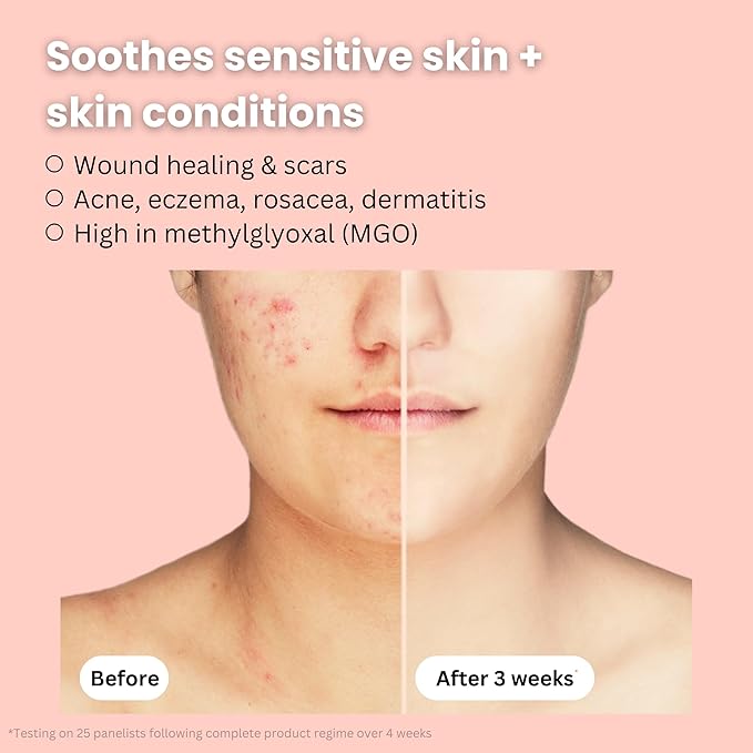 Organic Bee Venom + Manuka Honey Face Serum | Hydrating, Resurfacing, Collagen Booster | 2 month supply, 1oz/30ml | Made in New Zealand