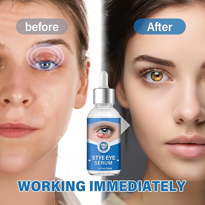Stye Eye Treatment, Gently Cleanses Lashes and Eyes, Restore Healthier Eye Skin, 30 ml