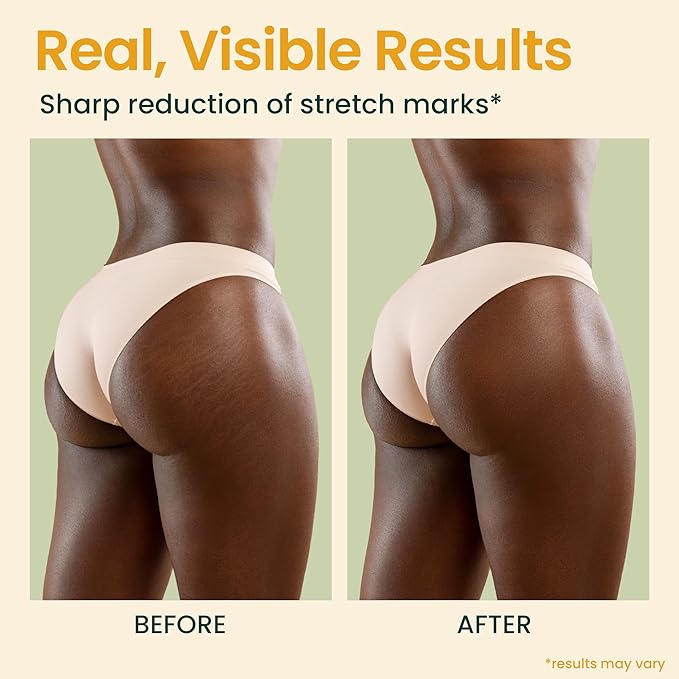 Bio Pure Skincare Oil for skin - Moisturizer for Dry Skin - Pregnancy Stretch Mark Prevention - Oil for Scars - Stretch Mark Treatment with Organic Sweet Almond Oil & Jojoba Oil for skin (8oz)