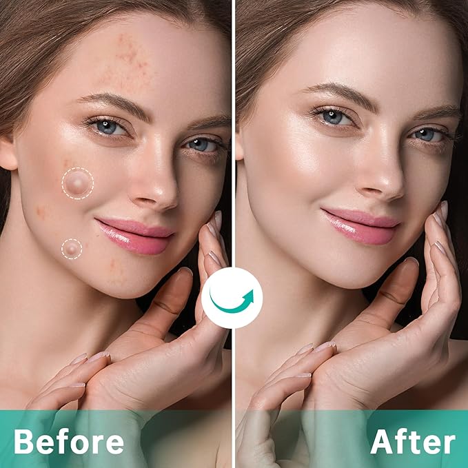 Pimple Patches for Face， Acne Patches/Hydrocolloid Patches for Covering Zits and Blemishes/Spot Care for Face，Absorb Fluid,4 size (210 Count)