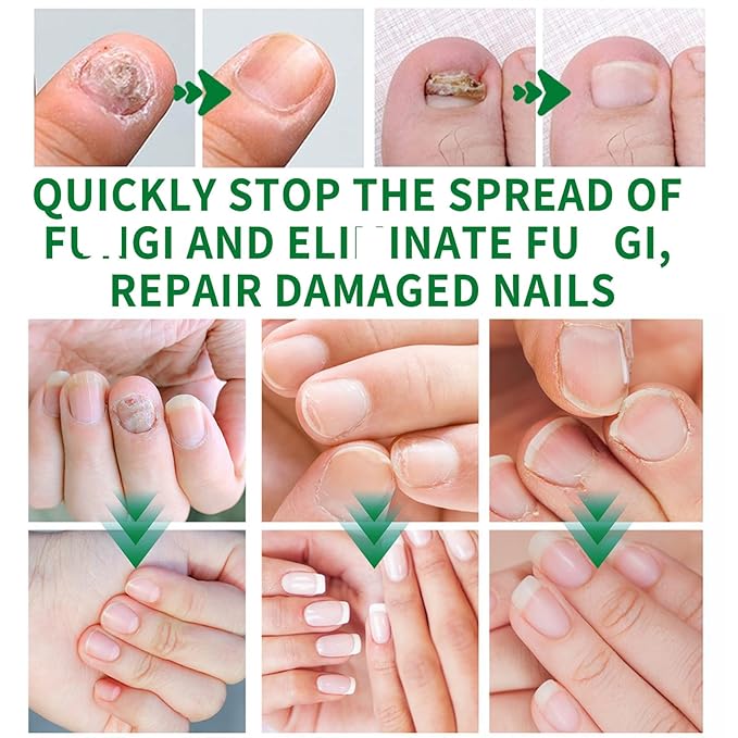 2Pcs Ginger Nail Strengthener for Damaged Nails, Hand and Foot Nail Growth Serum Kit, Ginger Nail Serum for Cracked Nails, Hand & Foot Strengthener Set, Fingernail Repair for Split, 30ML Each