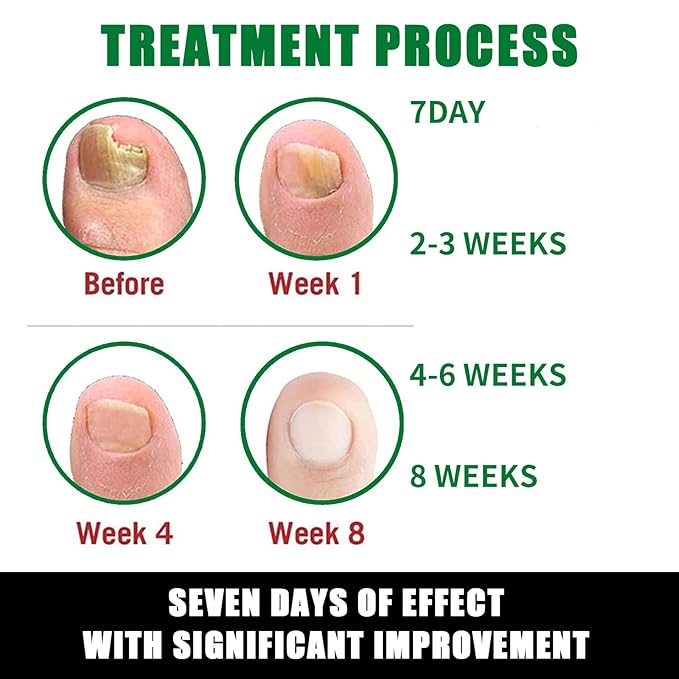 7days Nail Treatment, Ginger Nail Treatment, Multi-Purpose Nail Repair, Nail Nutrient Oil Strengthener Oil Serum Ginger Nail Growth Oil