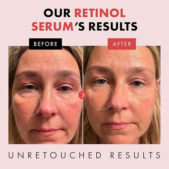 Eclat Skincare Retinol Serum for Face - Pure Retinol with Hyaluronic Acid & Vitamin E - Skin Care for Dark Spots - Anti Aging & Anti Wrinkle Formula - Resurfacing Retinoid Serum for Face 1 fl oz