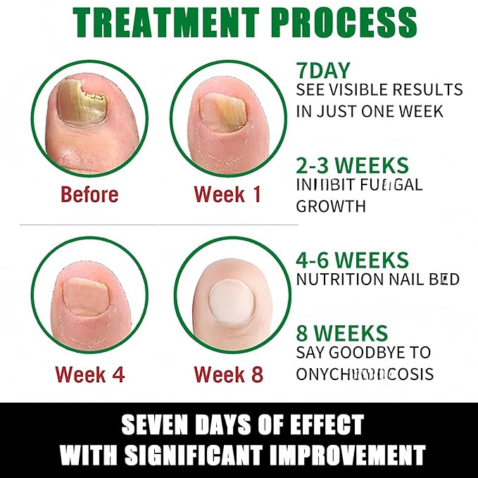 2Pcs Ginger Nail Strengthener for Damaged Nails, Hand and Foot Nail Growth Serum Kit, Ginger Nail Serum for Cracked Nails, Hand & Foot Strengthener Set, Fingernail Repair for Split, 30ML Each