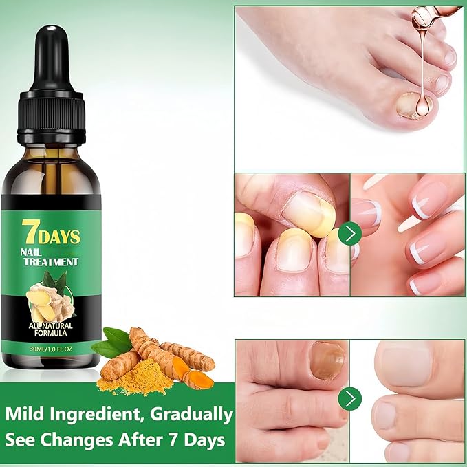 2Pcs Ginger Nail Growth and Strengthener-Nail Growth Serum-30ML Each Natural Nail Strengthener for Damaged Nails-Ginger Nail Treatment