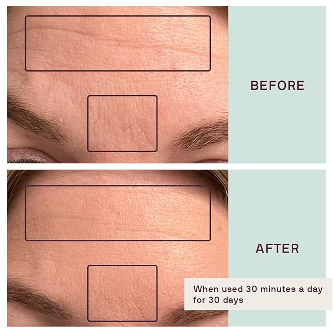 Dermaclara Face Patches Kit - Anti Wrinkle Patches for Forehead, Smile Lines, Silicone Anti-Wrinkle Frown Line Treatment, Up to 30 Uses - Kit: 1 Forehead, 2 Mouth, 2 Eye Patch & 1 Patch Prep Cleanser