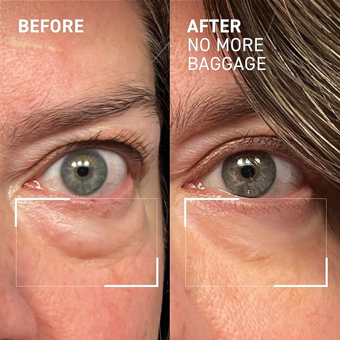 Dr. Brandt Needles No More, No More Baggage - Minimizes Under-Eye Bags, Puffiness & Dark Circles - 0.5 oz