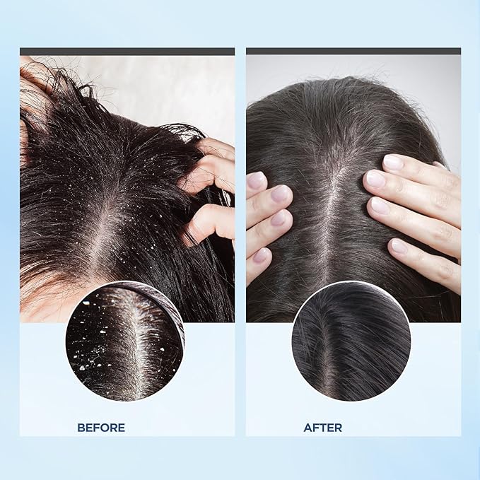Scalp Exfoliator Scrub,Itchy Scalp Treatment for Dandruff, No Sulfate Hair Scrub To Soothe a Dry, Flaky,Scalp,Removes Buildup,Clarifying Shampoo With Scrubber
