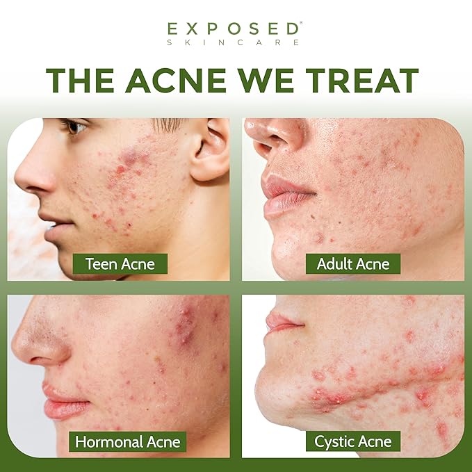 Exposed Skin Care Body Acne Kit – Dual Acne Treatment Serums + Body Wash and Exfoliating Body Cloth – Powerful System Eliminates Pimples and Breakouts to Quickly Clear Back and Body Acne