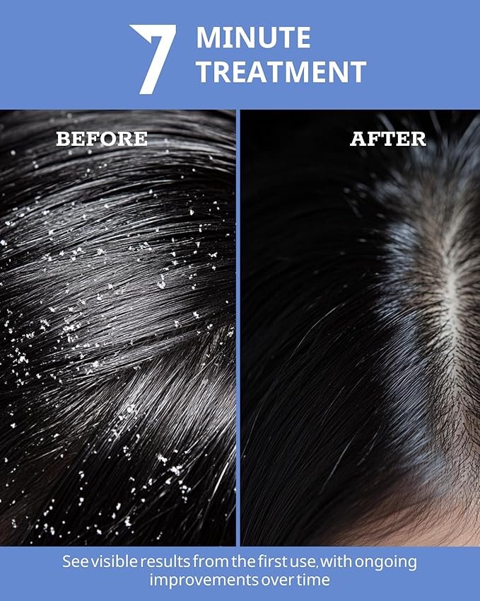 Folliculitis Hair Repair Mask - Effective Scalp Treatment for Seborrheic Dermatitis,Psoriasis, Dry Itchy Scalp, Dandruff Treatment | Nourishes Oily Hair – Ideal for Women