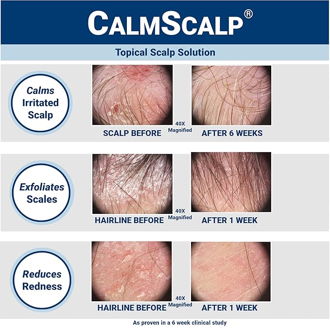 Solution | Calms Irritated Scalp | Controls Dry Scalp & Flakes | Reduces Scales & Redness | Clinically Proven | Free of Steroids | Non Shampoo Leave-On Scalp Treatment | 4 oz.
