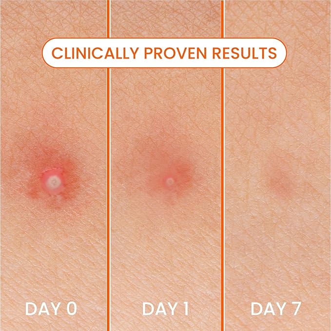 Bioré Pimple Patches, Cover & Conquer Blemish Patch, Medical Grade Ultra-Thin Hydrocolloid for Covering Zits and Blemishes, HSA/FSA Approved, 30 Count (Pack of 3)