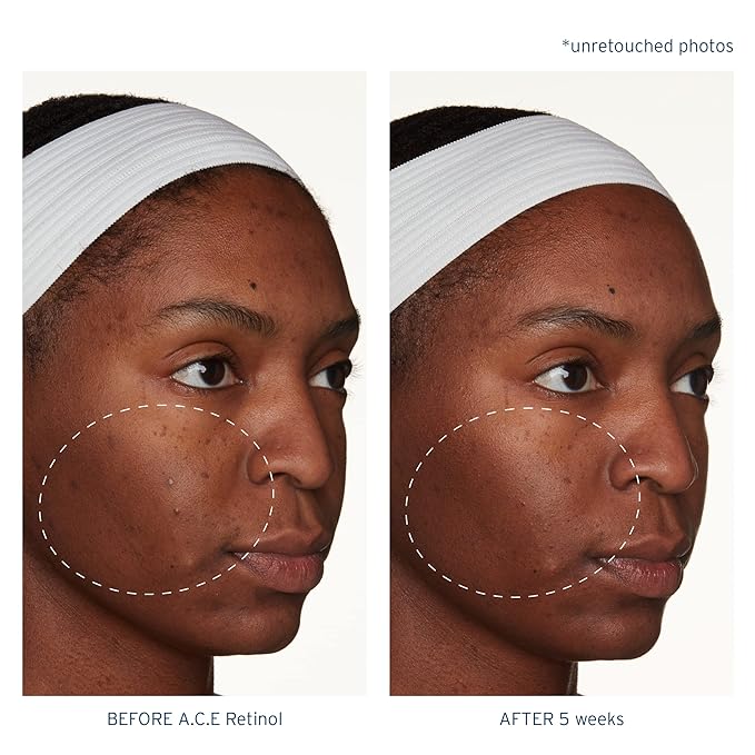 Santo Remedio, Piel Eterna, A.C.E. Retinol Intensive Rejuvenation Oil, Vitamin A, Vitamin C, Vitamin E, Squalane, Salicylic Acid, For Normal, Oily, or Combination Skin, 1 Fl. Oz.