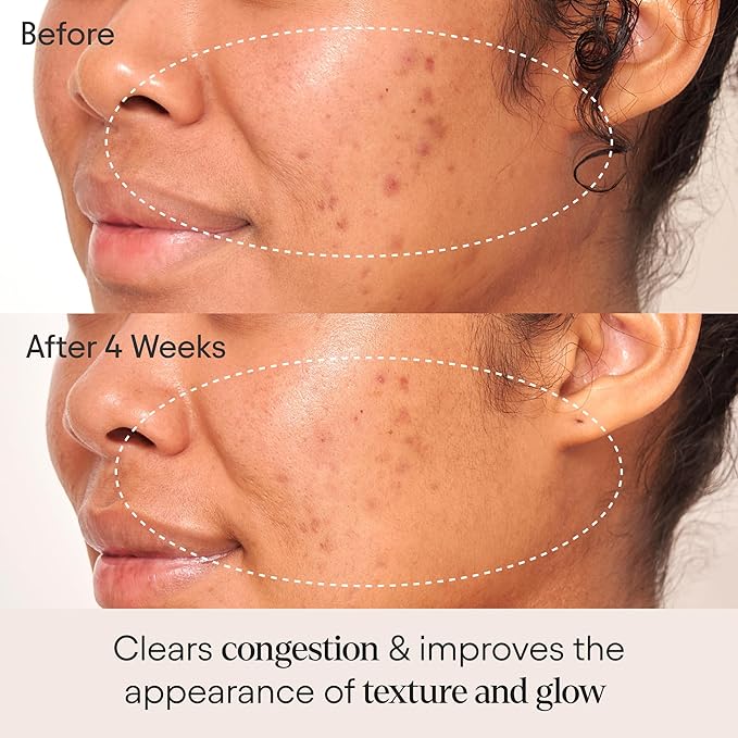 Alpyn Clarifying Facial Oil with Retinol & Pink Algae | Clear Congestion, Smooth Fine Lines, Improve Texture & Glow | 1 Fl Oz / 30 ml