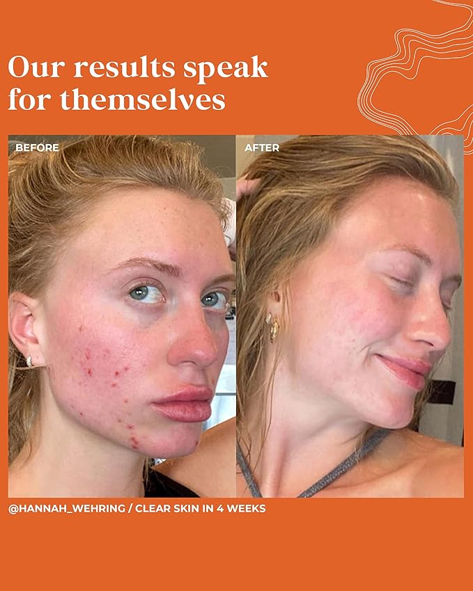 Clinical Clear + Control Healthy Skin Face Serum | All-Natural, Vegan, Cruelty-Free Spot Treatment for Clear Skin (1 FL OZ.)