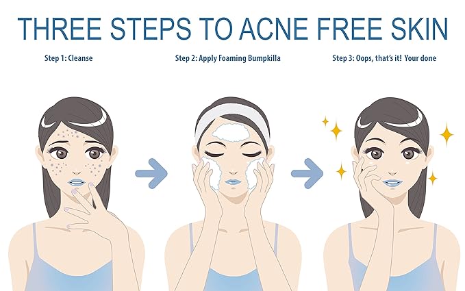 Acne Treatment For Sensitive Skin - 80% of Acne Gone in 4 Weeks. (Double Bottle)