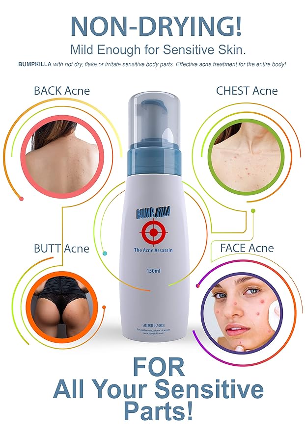 Acne Treatment For Sensitive Skin - 80% of Acne Gone in 4 Weeks. (Double Bottle)