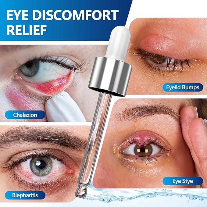 Stye Eye Treatment Serum, Eye Stye Remover for Chalazion, Blepharitis & Stye Removal, Natural Stye Eye Drops, Safe & Fast Relief, 30ml
